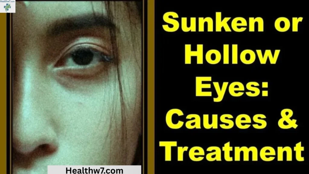 sunken-eyes