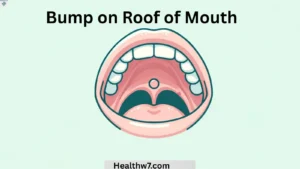 bump-on-roof-of-mouth