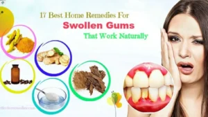 natural-remedies-for-swollen-gums