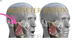 masseter-botox
