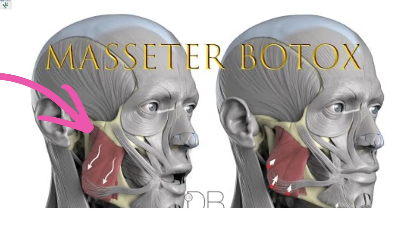 masseter-botox