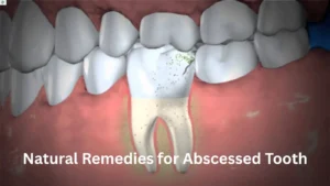 abscessed-tooth