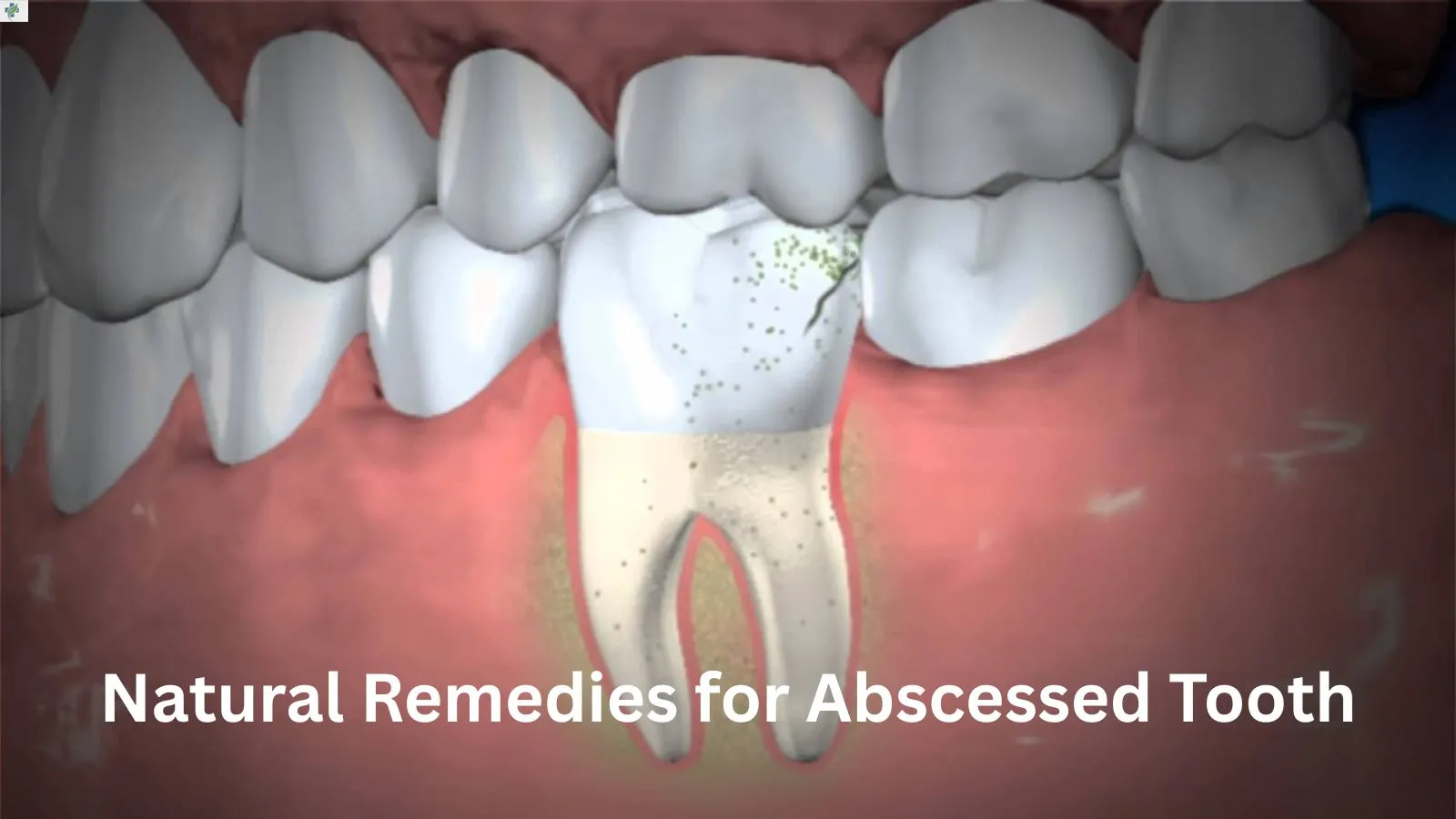abscessed-tooth
