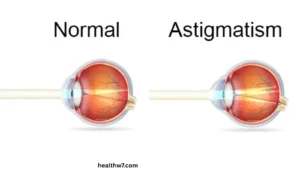 astigmatism-vs-blurry-vision