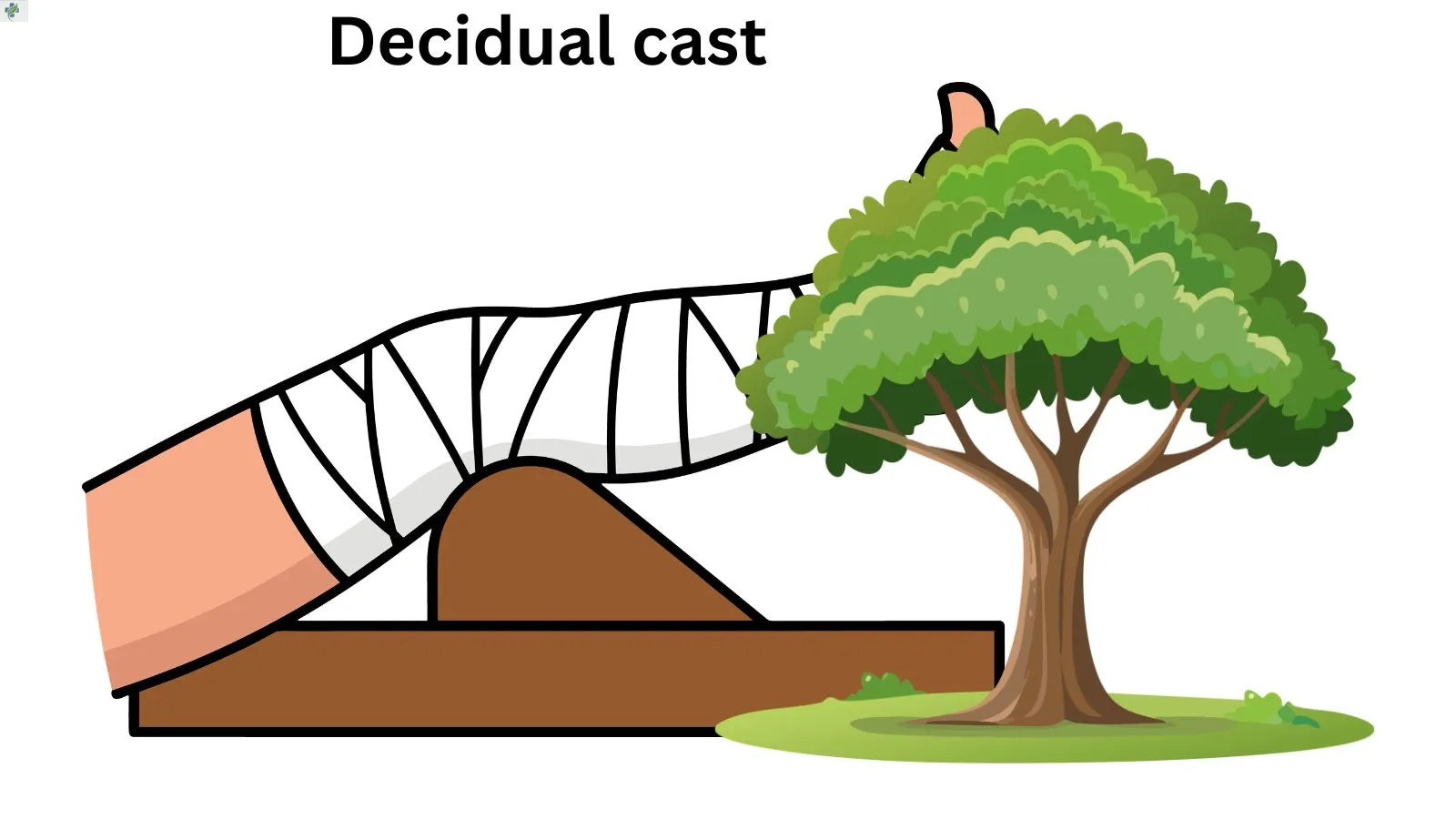 decidual-cast