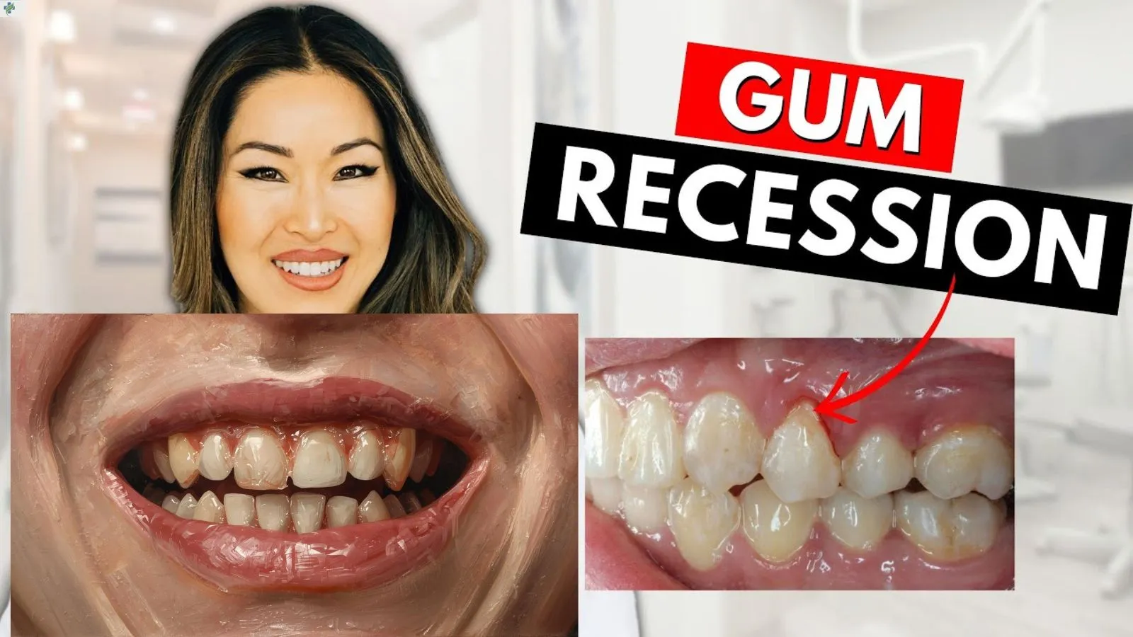 gum-recession