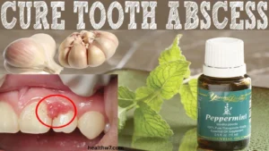natural-remedies-for-abscess-tooth-relief-fast