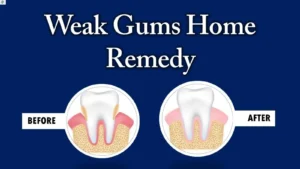 natural-remedies-for-gums
