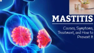 natural-remedies-for-mastitis