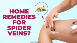 natural-remedy-for-spider-veins