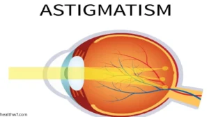 stigmatism-of-eye